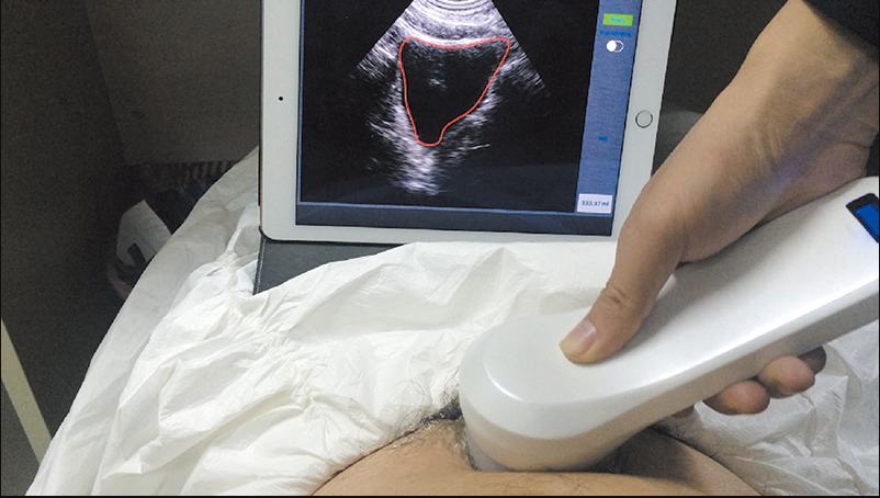 Wireless Ultrasound Probe