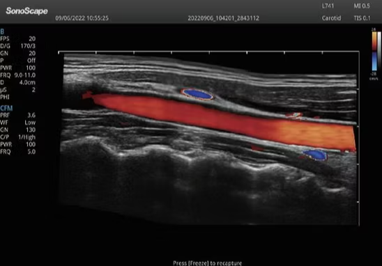 SonoScape P12 Elite Ultrasound Machine