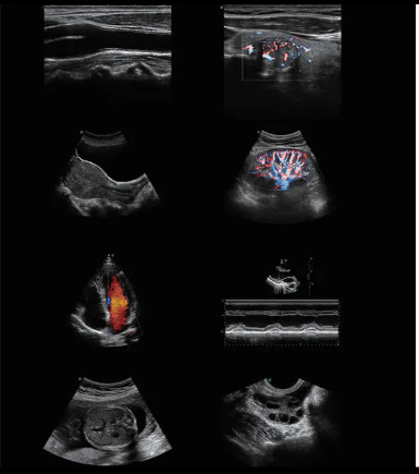 SonoScape P9 Ultrasound Machine