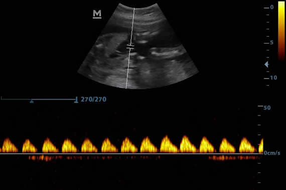 Ultrasound Device