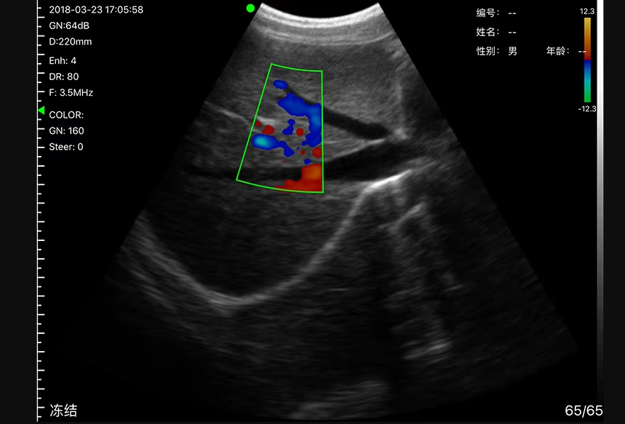 SonoSmart 2 in 1 Convex-TVS Wireless Ultrasound Probe