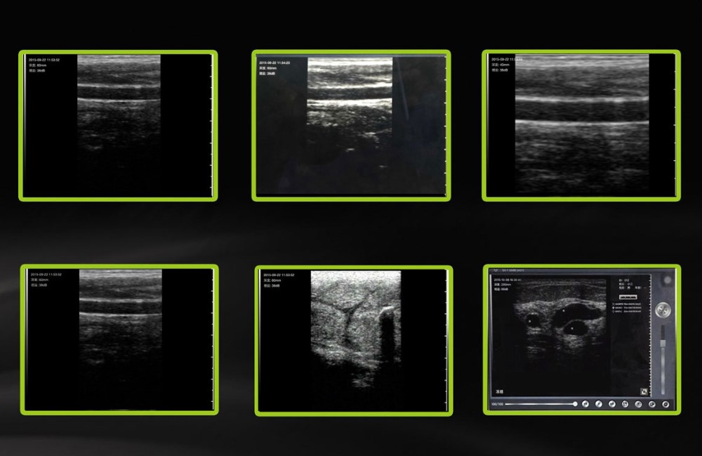 Portable & wireless ultrasound machine