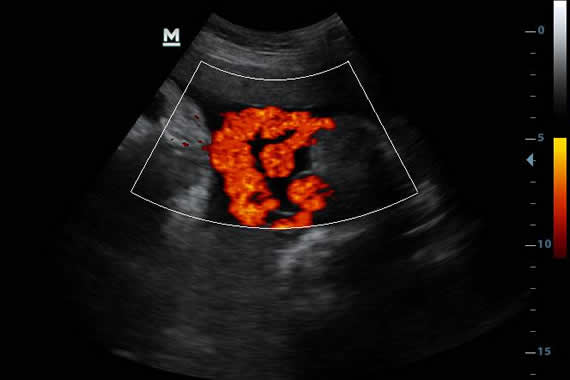 Mindray DP 30 Portable Ultrasound Machine