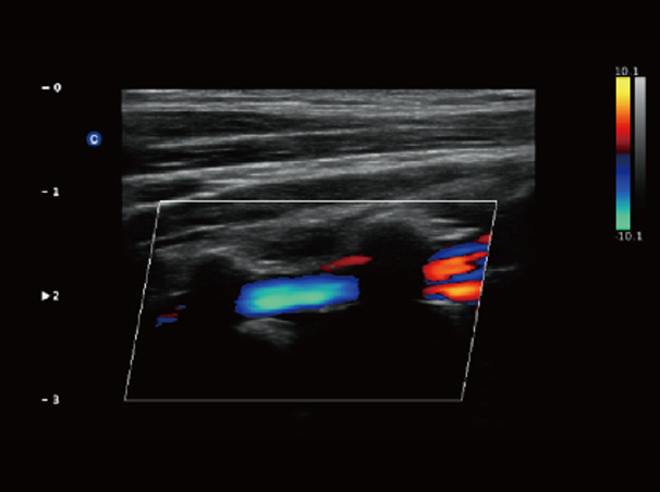 Chison QBit-3 Ultrasound Machine