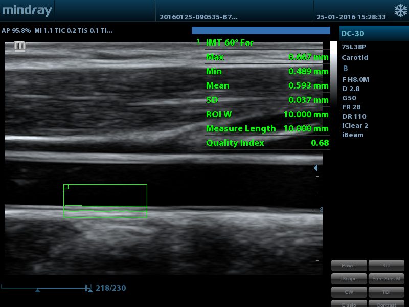 Mindray DC-30 Ultrasound System 4D Color Doppler