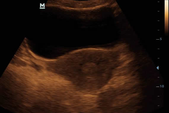 Ultrasound Device