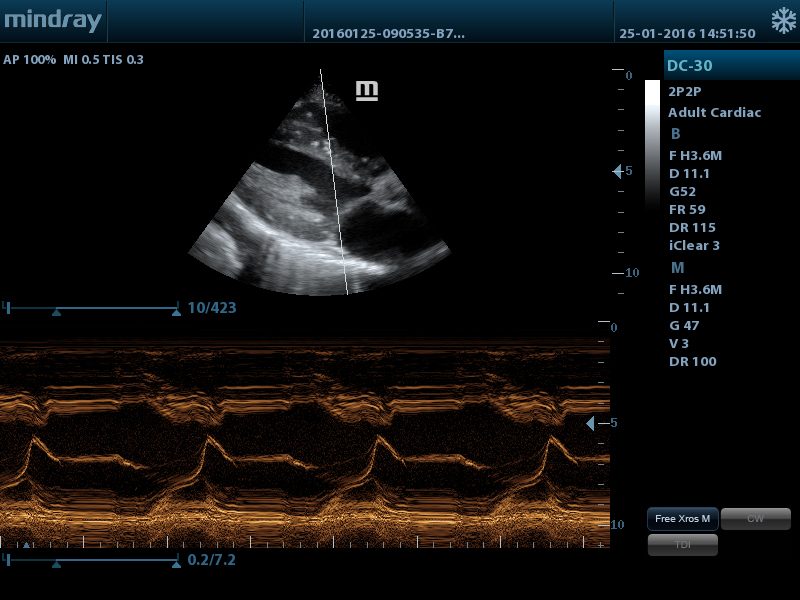 Mindray DC-30 Ultrasound System 4D Color Doppler